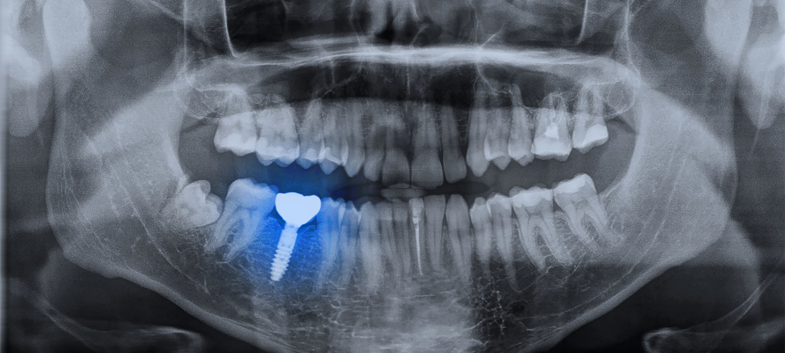 Panoramic-Dental-X-ray-Image-Mouth-Of-Adult-Man