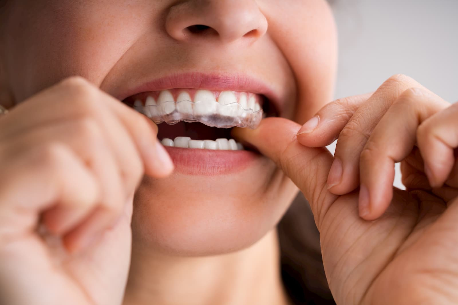 clear-aligners