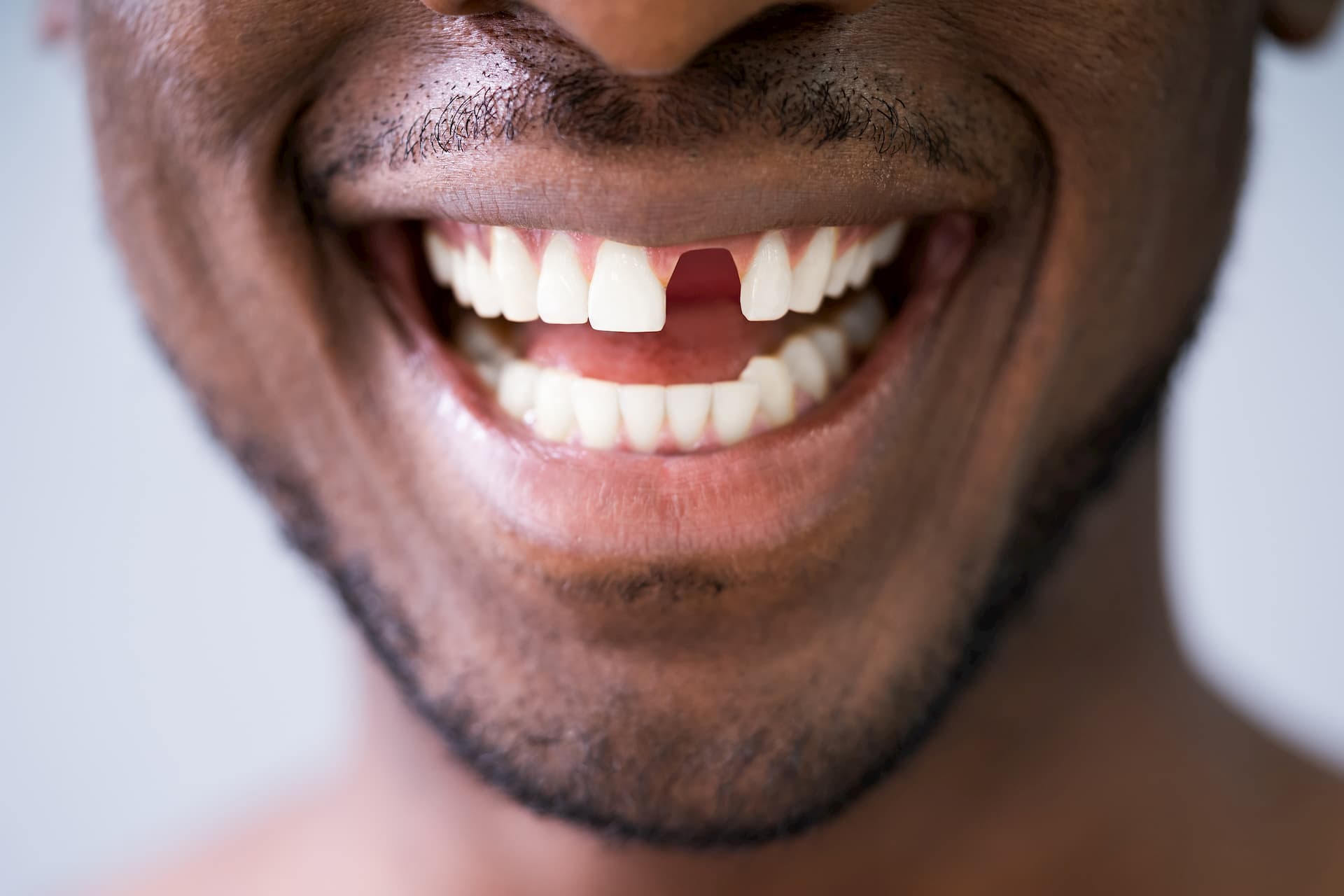 Man-with-missing-front-tooth