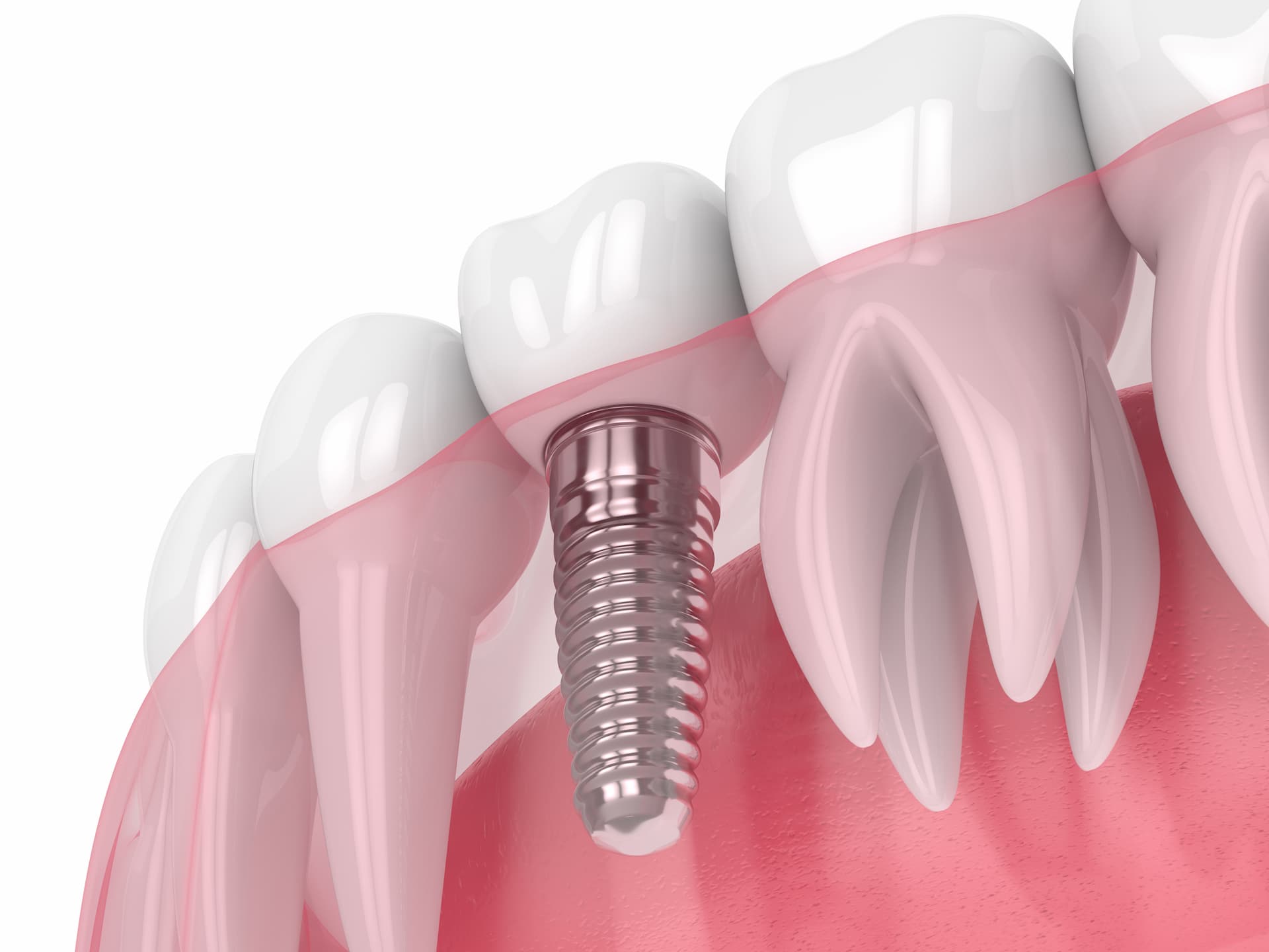 Dental-Implant