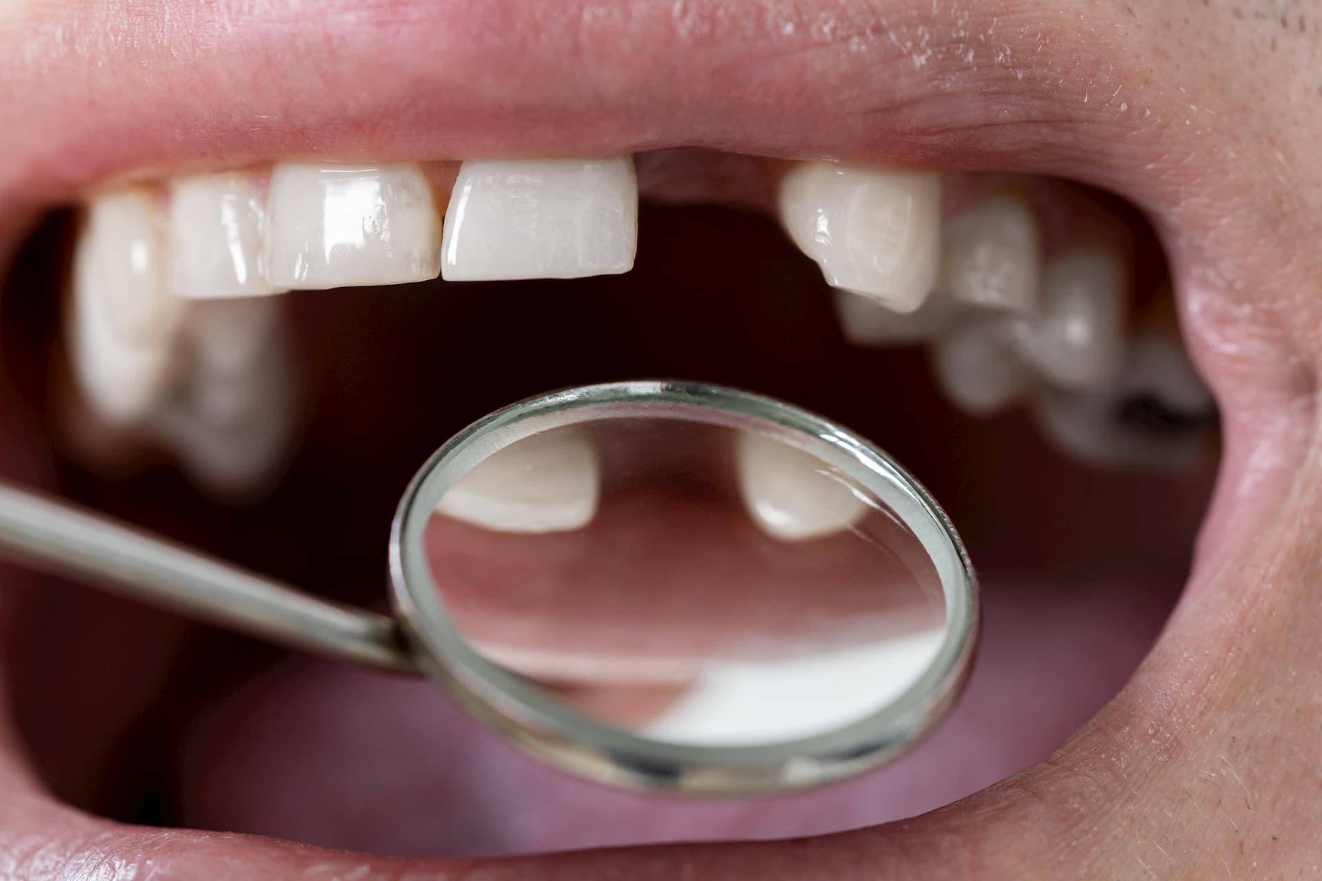 Male-Patient-With-Missing-Teeth