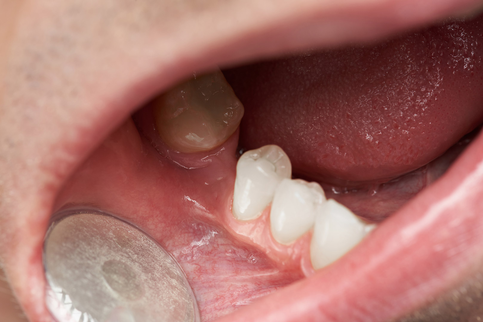 Tooth-Gap-In-Man-Mouth-Close-up