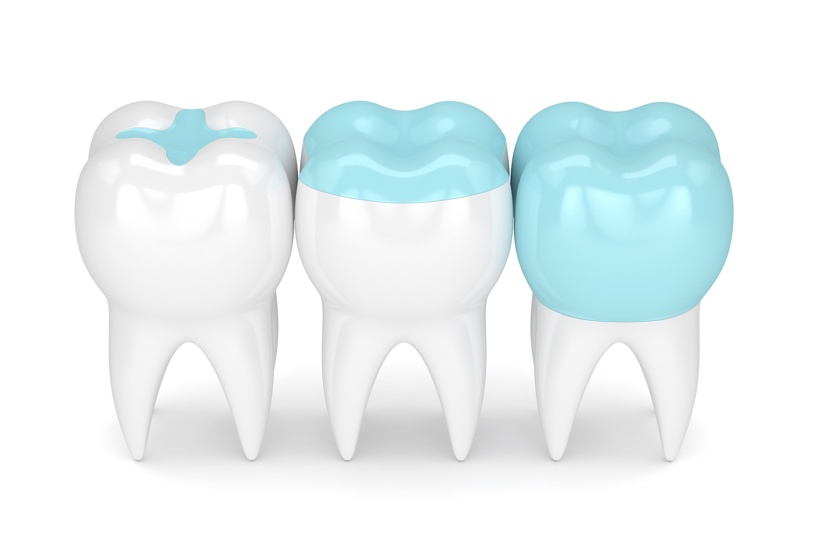 partial-crowns-example